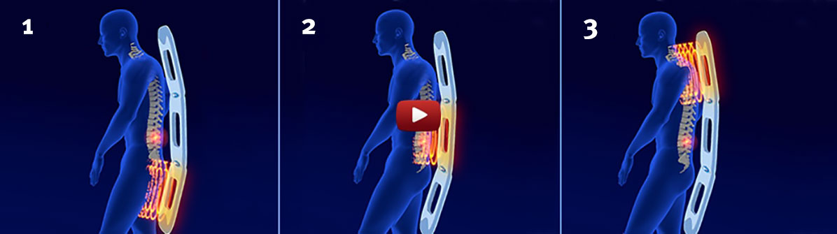 Video über die Anwedung eines Applikators 